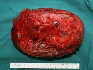 小兒嗜鉻細胞瘤 小兒嗜鉻細胞瘤