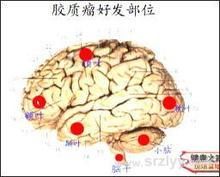 腦膠質瘤 腦膠質瘤