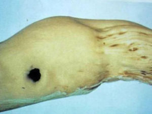 葡萄莖痘病 葡萄莖痘病