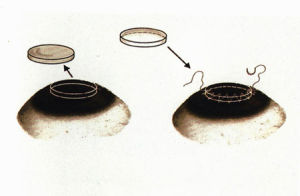 角膜移植手術 角膜移植手術