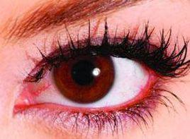 發熱伴眼睛充血 發熱伴眼睛充血