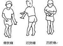 舞蹈樣步態 舞蹈樣步態