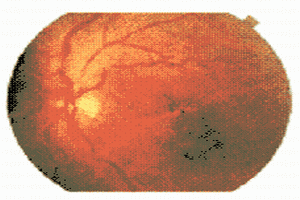 糖尿病性視網膜病