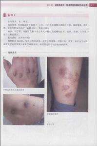 營養與代謝障礙性皮膚病