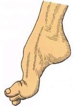 馬蹄外翻足 馬蹄外翻足