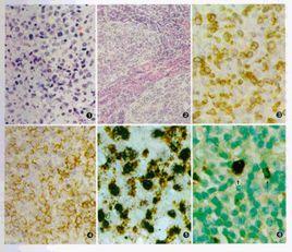 T淋巴母細胞性淋巴瘤 T淋巴母細胞性淋巴瘤