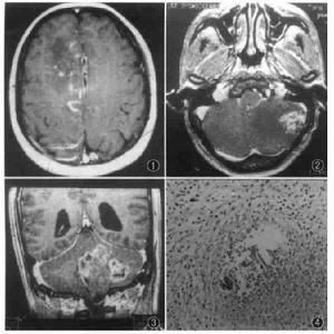 東方馬型腦炎 東方馬型腦炎