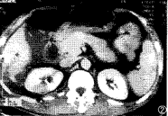 妊娠期肝血腫及破裂