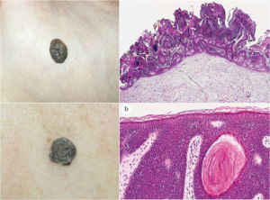 脂溢性角化病 脂溢性角化病