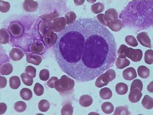 腹壁纖維肉瘤 腹壁纖維肉瘤