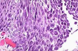 單純皰疹病毒肺炎