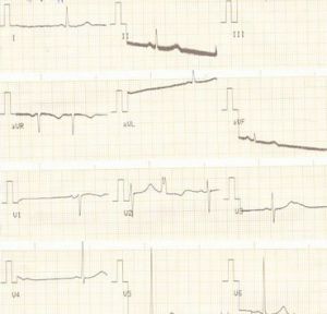 心電圖等可診斷腦梗塞