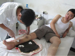 脛骨骨髓炎 脛骨骨髓炎