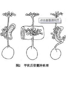 甲狀舌管囊腫 甲狀舌管囊腫