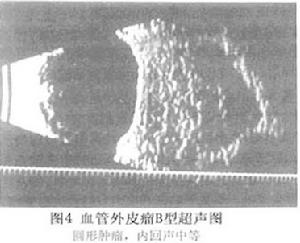 眼眶血管外皮瘤