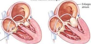 經皮球囊二尖瓣成形術 經皮球囊二尖瓣成形術