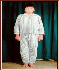 急性腎小球腎炎