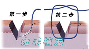 （圖）FUT顯微植髮技術