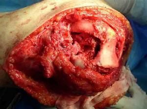 膝關節結核 膝關節結核