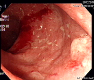 潰瘍性大腸炎在內視鏡下可見潰瘍出血。