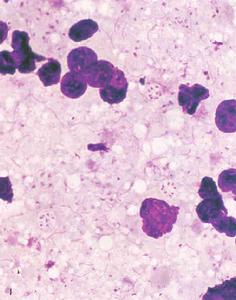 肺孢子蟲 肺孢子蟲