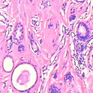 外陰基底細胞癌 外陰基底細胞癌