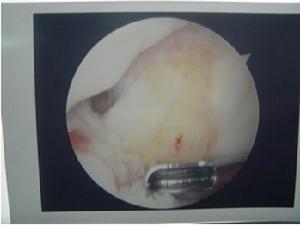 膝關節鏡所見圖樣