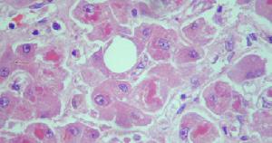 酒精中毒性肌病