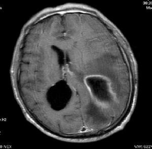 （圖）腦膿腫