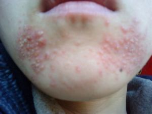 羊鬍子瘡 羊鬍子瘡