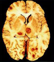 先天性弓形蟲病