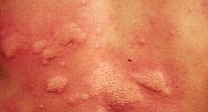 急性過敏性蕁麻疹