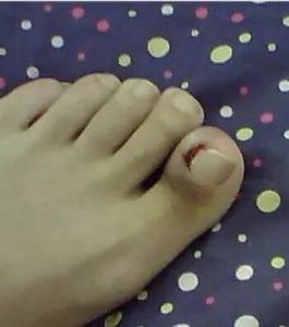 甲溝炎和甲下膿腫