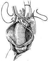 胸升主動脈動脈瘤
