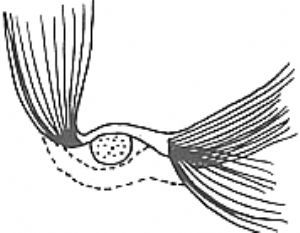 咽鼓管異常開放症