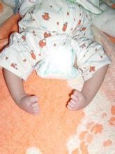 先天性馬蹄內翻足 先天性馬蹄內翻足