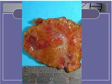 肝局灶性結節樣增生