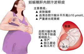 孕期膽汁淤積症 孕期膽汁淤積症