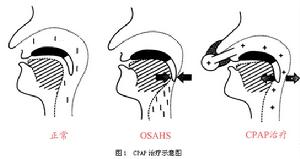 發作性嗜睡強食綜合徵