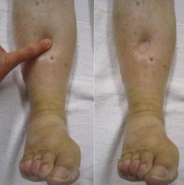 孕婦小腿浮腫 孕婦小腿浮腫