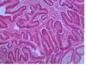 （圖）十二指腸類癌