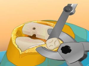 膝關節置換手術