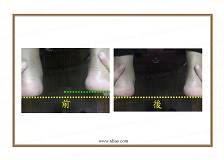 體雕 - 改善長短腳 (非先天性因素之長短腳)