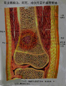 脛骨骨髓炎的病理