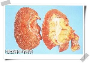 膜性腎小球腎炎 膜性腎小球腎炎