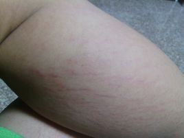 毛細血管破裂 毛細血管破裂