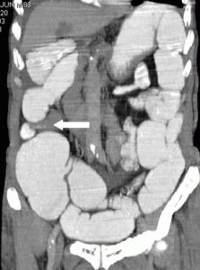 不全性腸梗阻 不全性腸梗阻