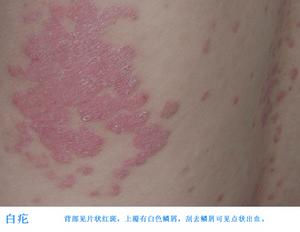 白疕