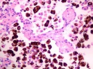 氣球狀細胞痣 氣球狀細胞痣