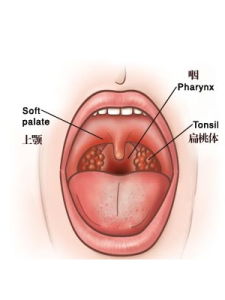 急性喉炎 急性喉炎